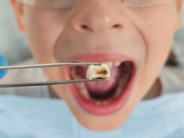 Best Emergency Dentist for Lost Fillings or Crowns in Black Jack, MO